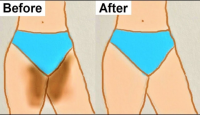 Ladies, If Your Inner Thighs Are Dark, See Easy Ways You Can Lighten Them